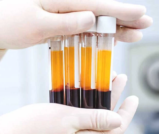 Platelet Rich Plasma therapy: the new boom for your skin and hair!