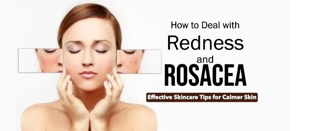 How to Deal with Redness and Rosacea: Effective Skincare Tips for Calmer Skin