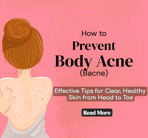 How to Prevent Body Acne (Bacne): Effective Tips for Clear, Healthy Skin from Head to Toe