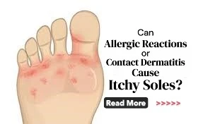 Can Allergic Reactions or Contact Dermatitis Cause Itchy Soles? Understanding Triggers and Relief Tips