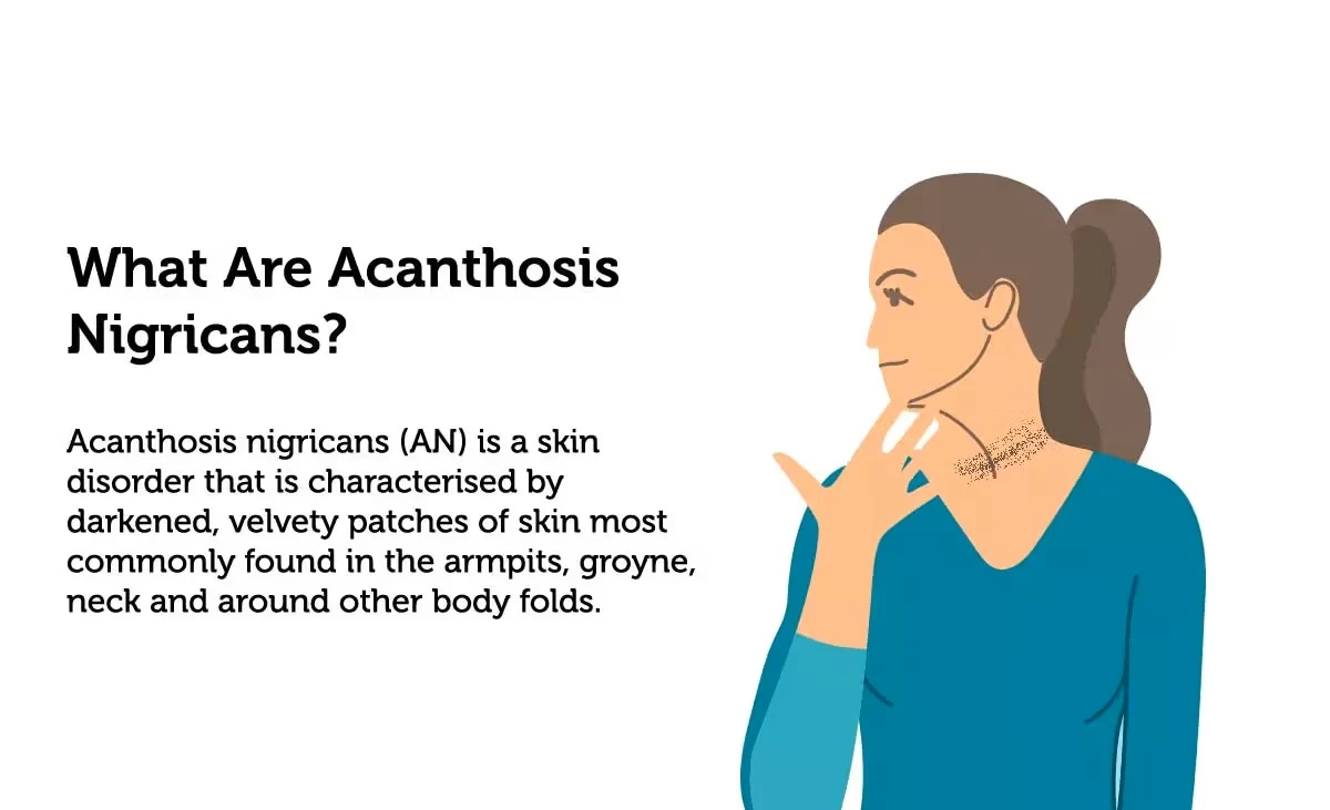 Can Acanthosis Nigricans Cause Dark Skin on the Neck? Understanding the Causes and Signs