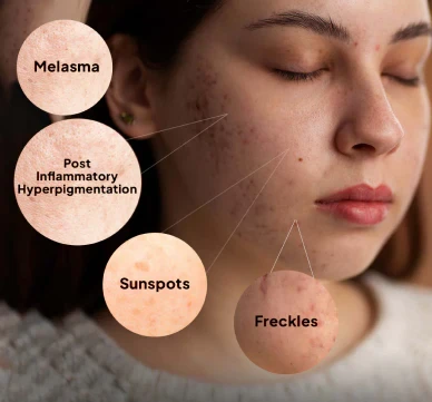 What Are the Most Common Types of Pigmentation on the Face? Understanding Melasma, Sun Spots, Post-Inflammatory Hyperpigmentation, and Freckles