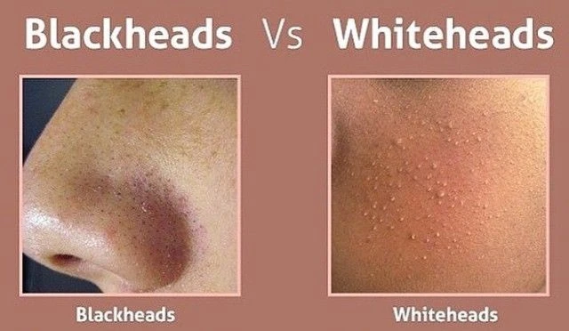 What Is the Difference Between Blackheads and Whiteheads? Understanding Causes, Appearance, and Treatment