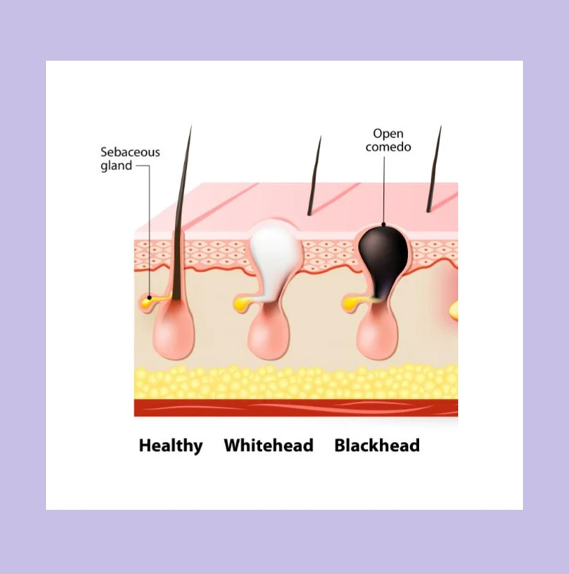 Why Do Blackheads Look Black and Why Are Whiteheads Closed? Understanding the Science Behind Clogged Pores