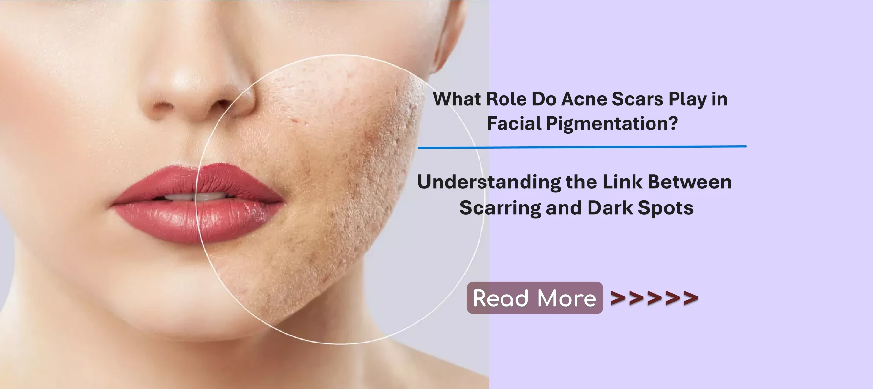 What Role Do Acne Scars Play in Facial Pigmentation? Understanding the Link Between Scarring and Dark Spots