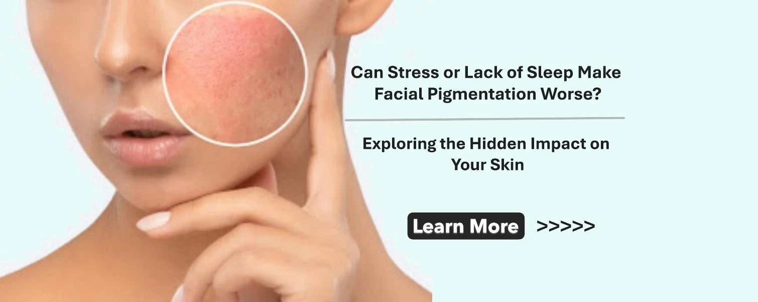 Can Stress or Lack of Sleep Make Facial Pigmentation Worse? Exploring the Hidden Impact on Your Skin