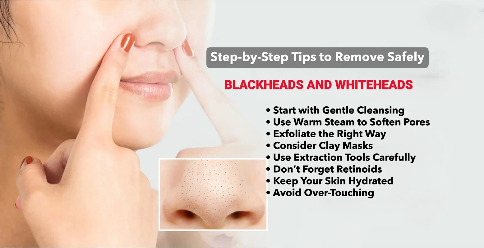 How Can You Safely Remove Blackheads and Whiteheads? Expert Tips for Clearer, Smoother Skin