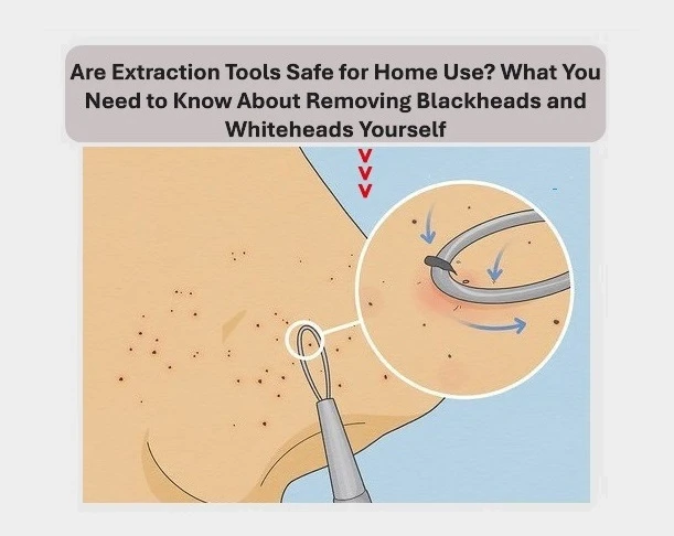 Are Extraction Tools Safe for Home Use? What You Need to Know About Removing Blackheads and Whiteheads Yourself