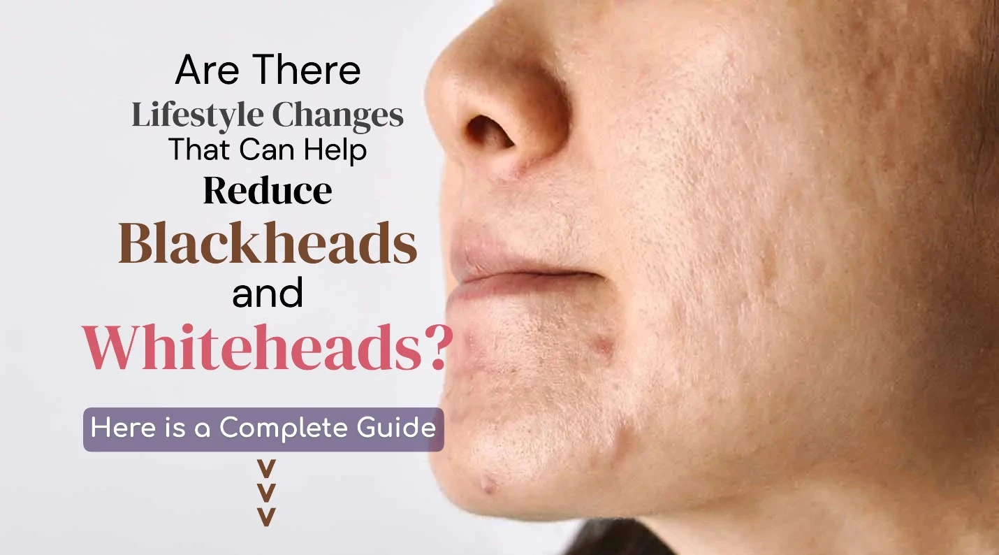 Are There Lifestyle Changes (Diet, Hydration, Stress) That Can Help Reduce Blackheads and Whiteheads? Exploring How Daily Habits Impact Clearer Skin