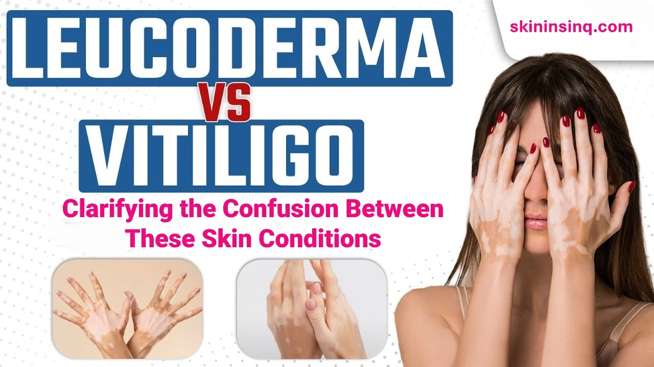 What’s the Difference Between Vitiligo and Leucoderma? Clarifying the Confusion Between These Skin Conditions