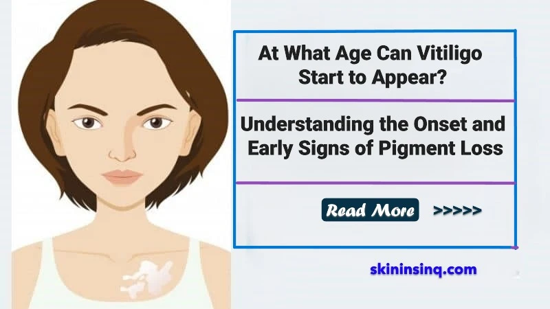 At What Age Can Vitiligo Start to Appear? Understanding the Onset and Early Signs of Pigment Loss
