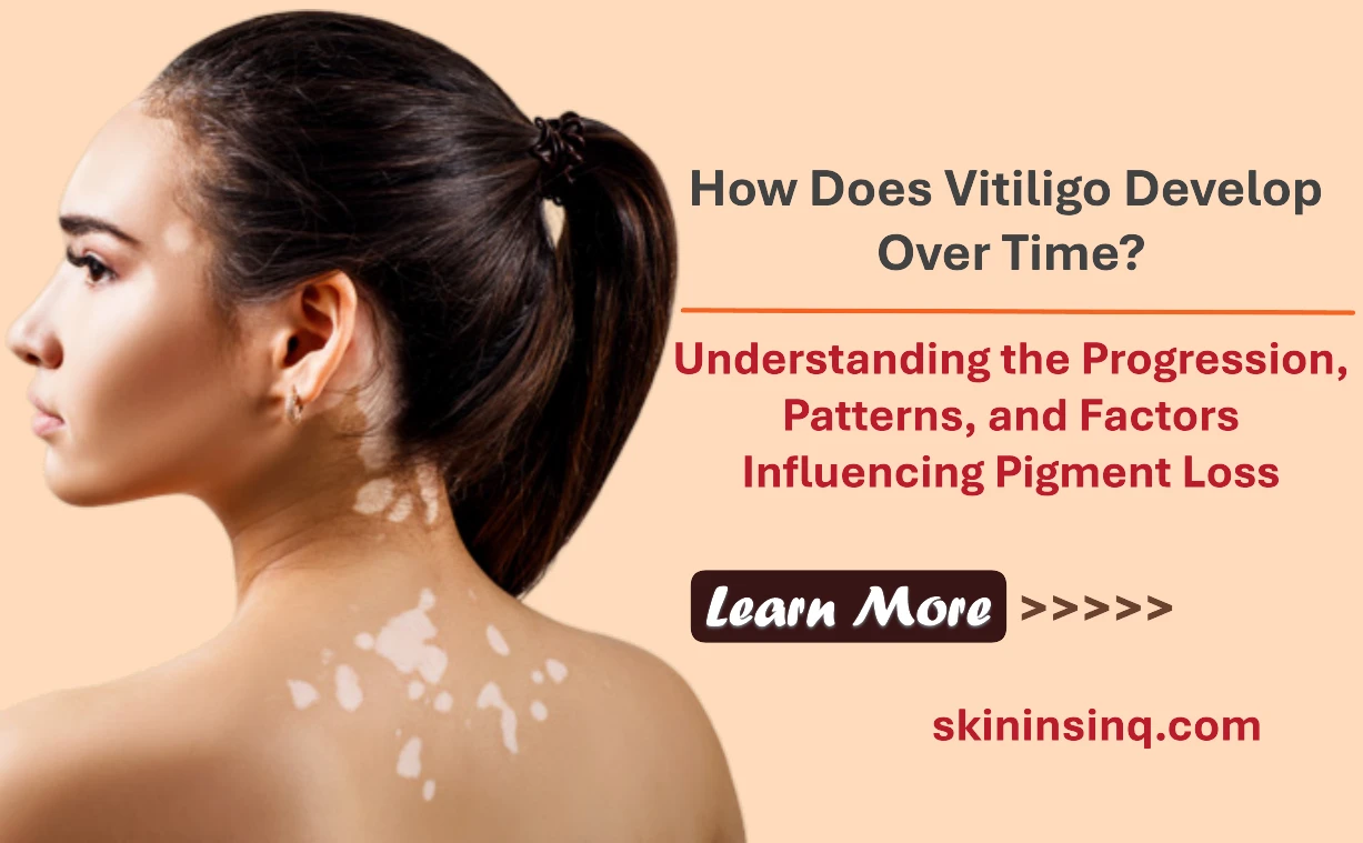 How Does Vitiligo Develop Over Time? Understanding the Progression, Patterns, and Factors Influencing Pigment Loss