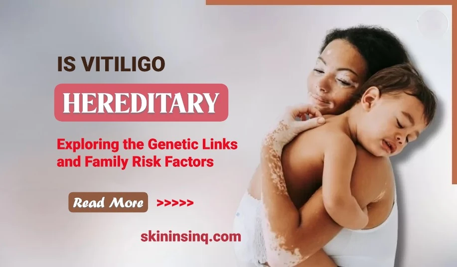 Is Vitiligo Hereditary? Exploring the Genetic Links and Family Risk Factors