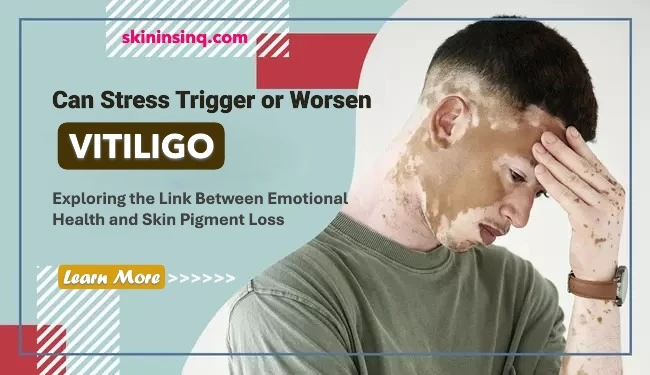 Can Stress Trigger or Worsen Vitiligo? Exploring the Link Between Emotional Health and Skin Pigment Loss