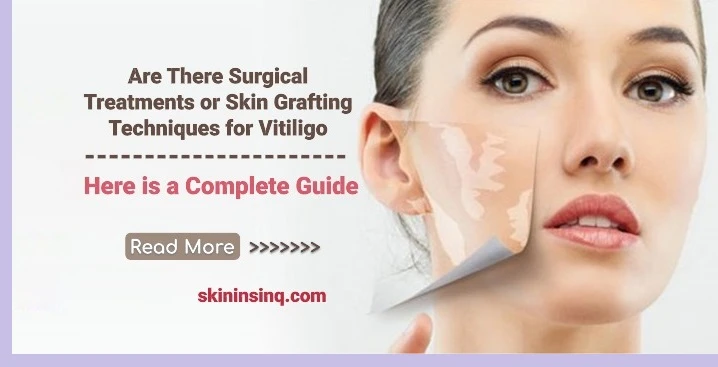 Are There Surgical Treatments or Skin Grafting Techniques for Vitiligo? Exploring Advanced Options for Repigmentation