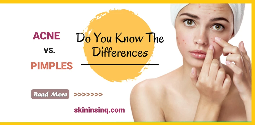 What’s the Difference Between Acne and Pimples? Understanding the Key Distinctions for Better Skin Care