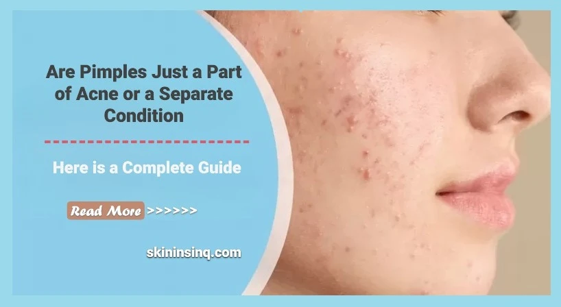 Are Pimples Just a Part of Acne or a Separate Condition? Understanding Their Connection