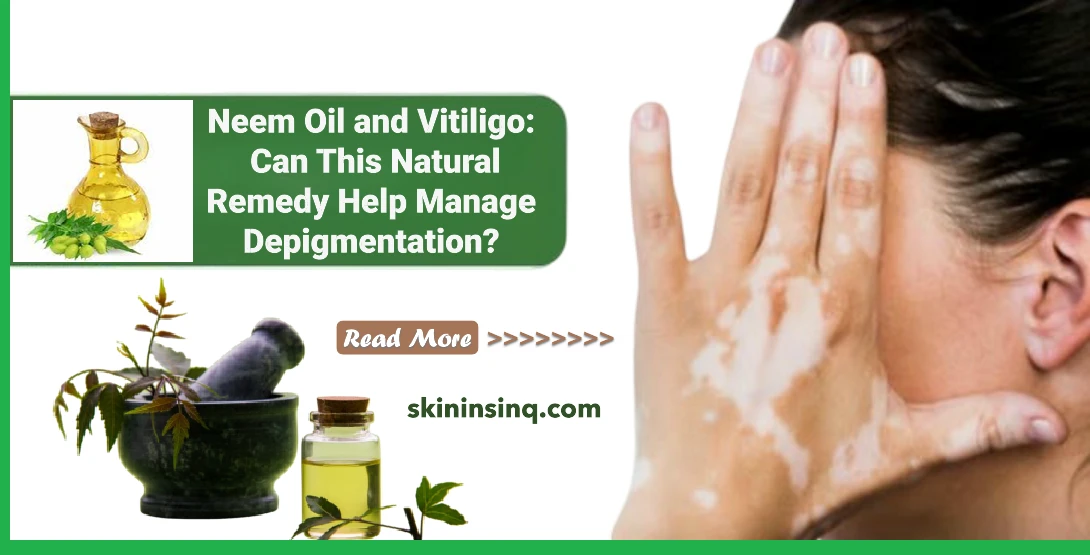 Neem Oil and Vitiligo: Can This Natural Remedy Help Manage Depigmentation?