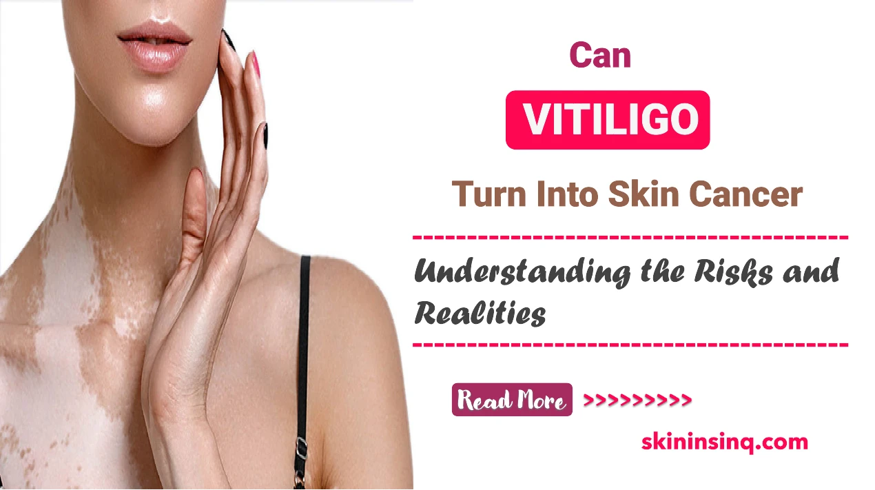 Can Vitiligo Turn Into Skin Cancer? Understanding the Risks and Realities