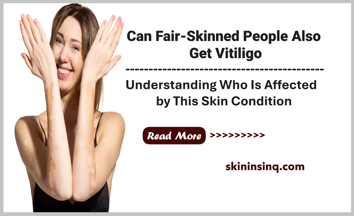Can Fair-Skinned People Also Get Vitiligo? Understanding Who Is Affected by This Skin Condition