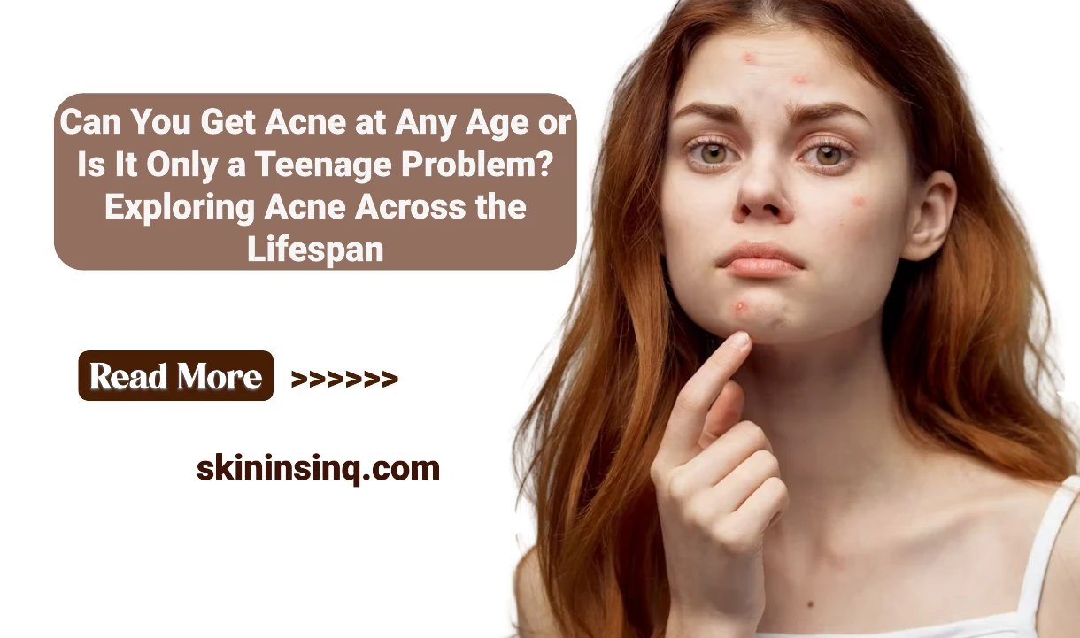Can You Get Acne at Any Age or Is It Only a Teenage Problem? Exploring Acne Across the Lifespan