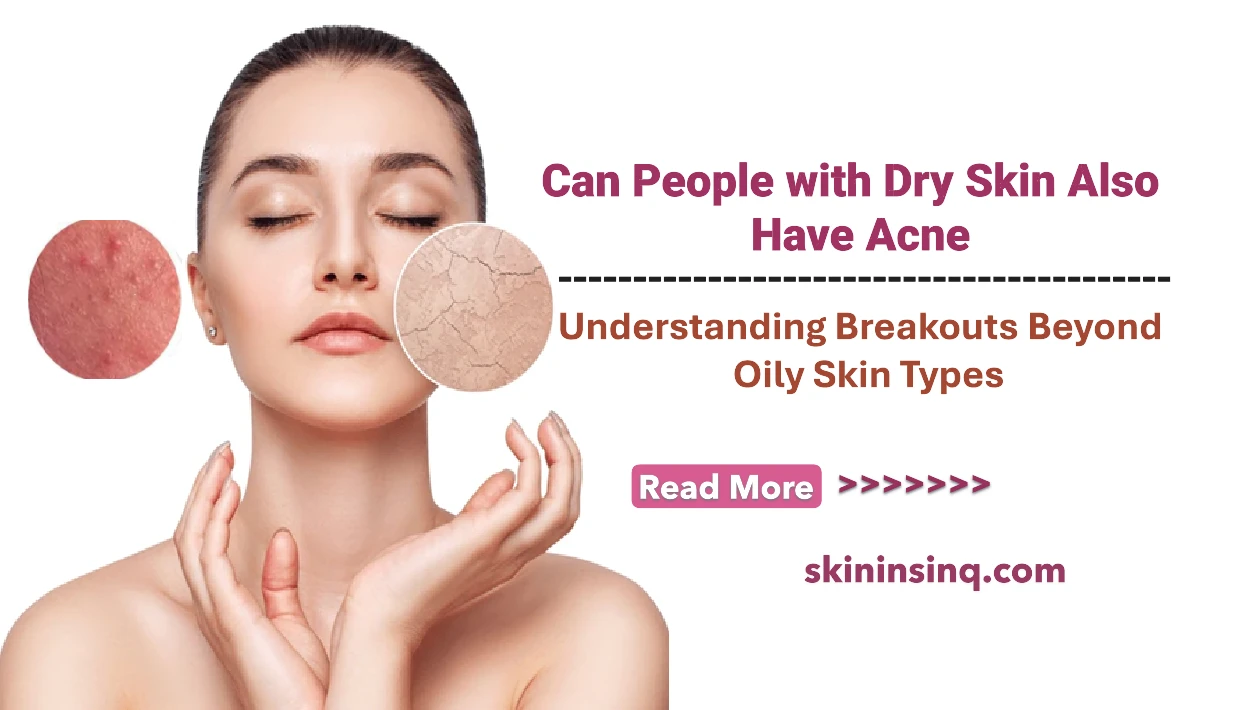 Can People with Dry Skin Also Have Acne? Understanding Breakouts Beyond Oily Skin Types