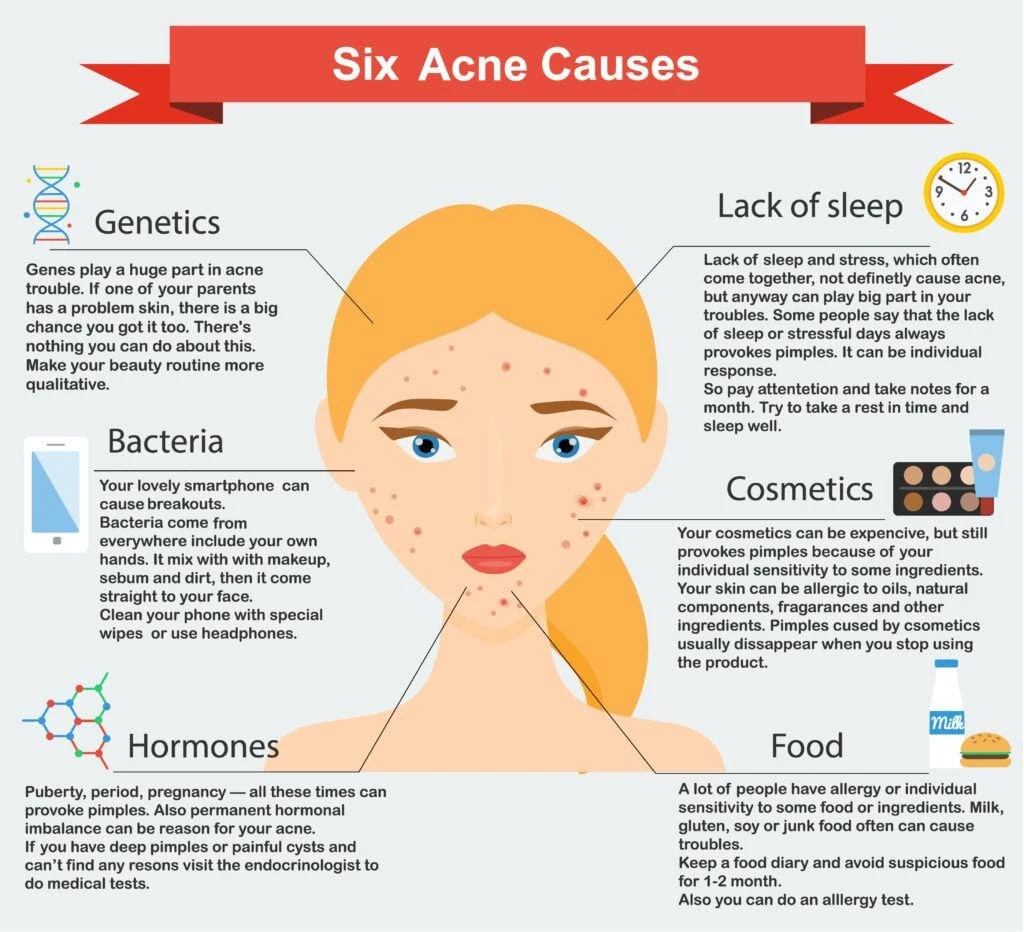 What causes acne and how can i treat it?