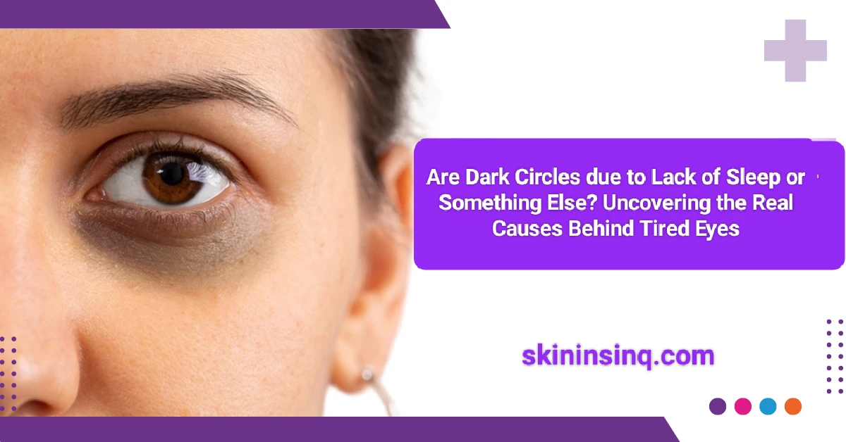 Are Dark Circles Due to Lack of Sleep or Something Else? Uncovering the Real Causes Behind Tired Eyes