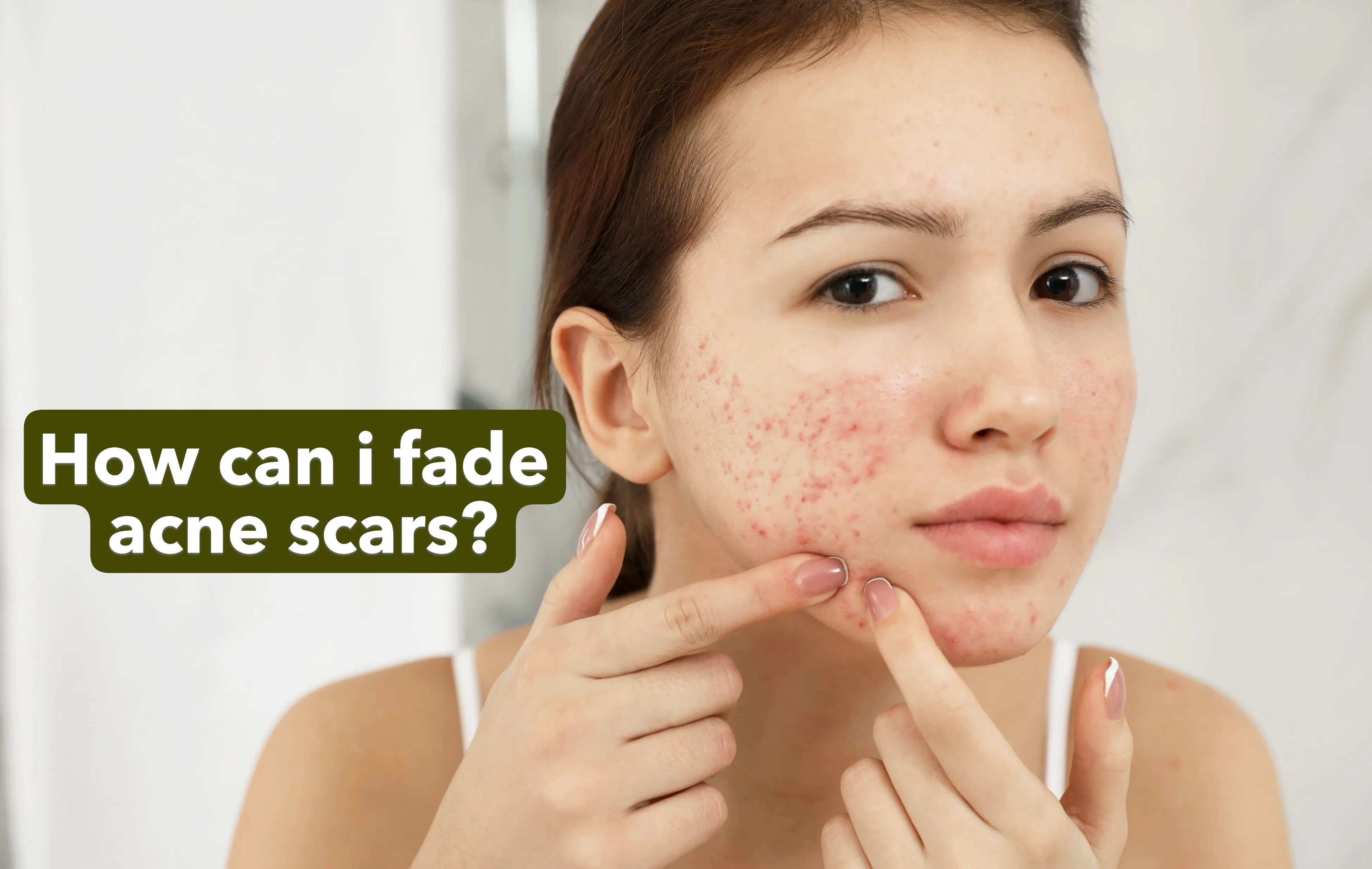 How can i fade acne scars?
